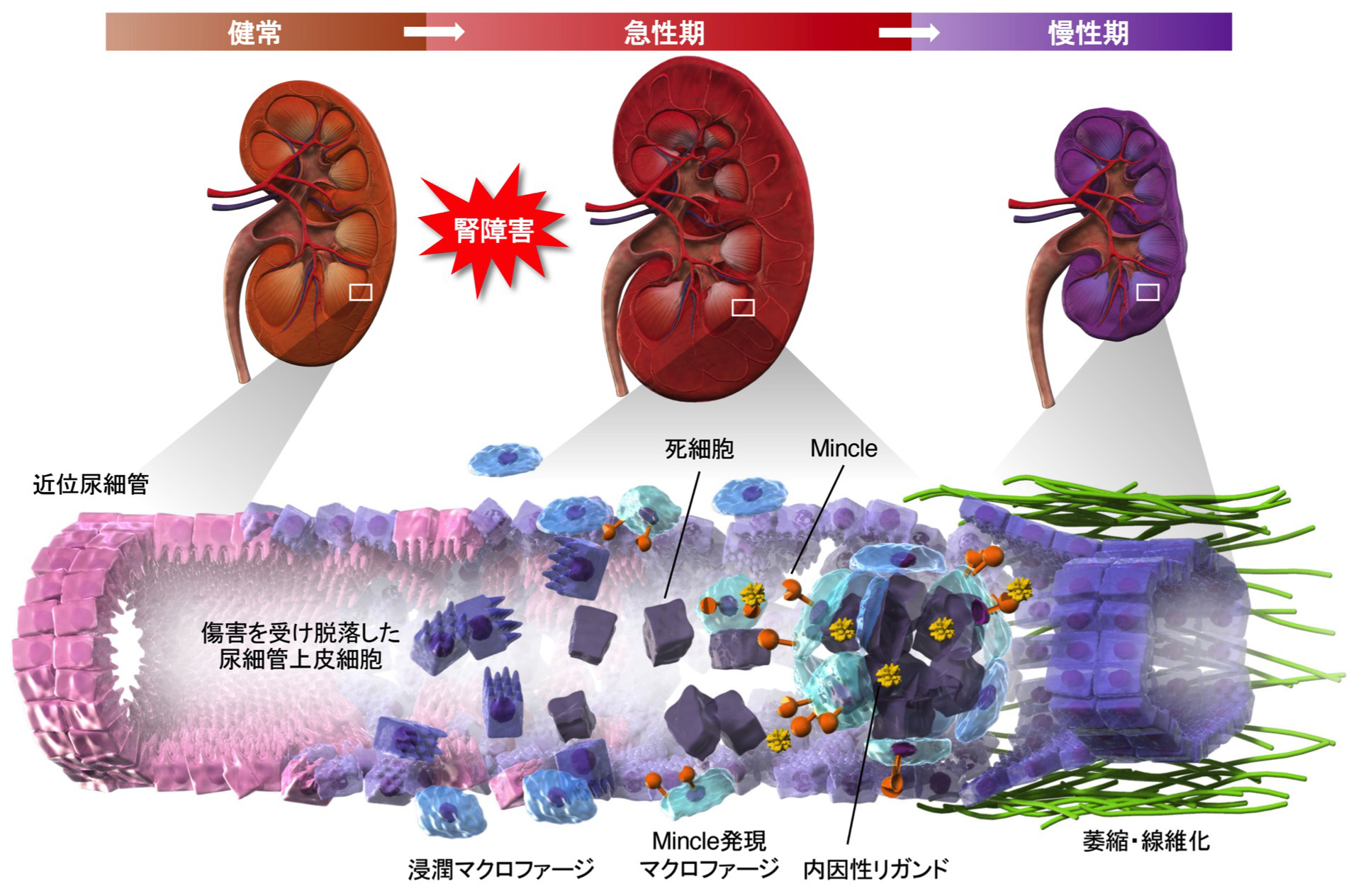図:死細胞センサーMincleによる急性腎障害の慢性化メカニズム